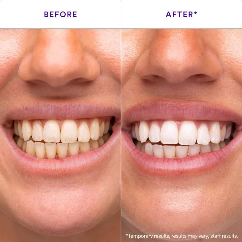 V34 Teeth Whitening Strips