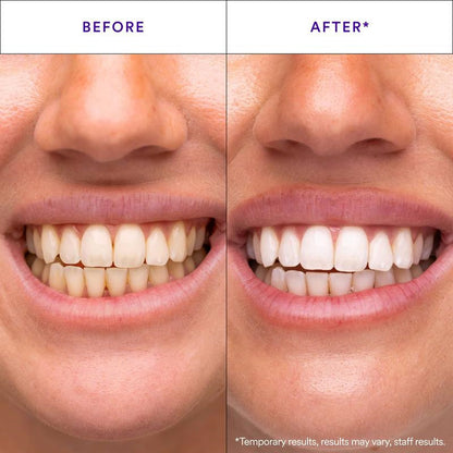 V34 Teeth Whitening Strips